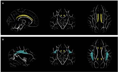 White Matter Correlates of Theory of Mind in Patients With First-Episode Psychosis